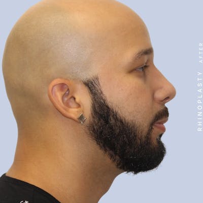 Men's Nose Before & After Gallery - Patient 108763901 - Image 10