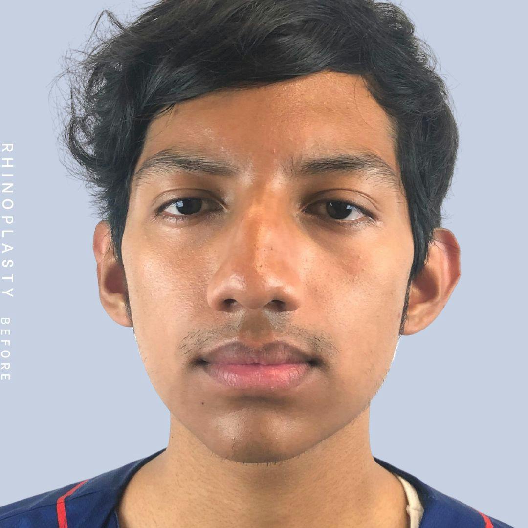 Nose Before & After Gallery - Patient 108743681 - Image 1