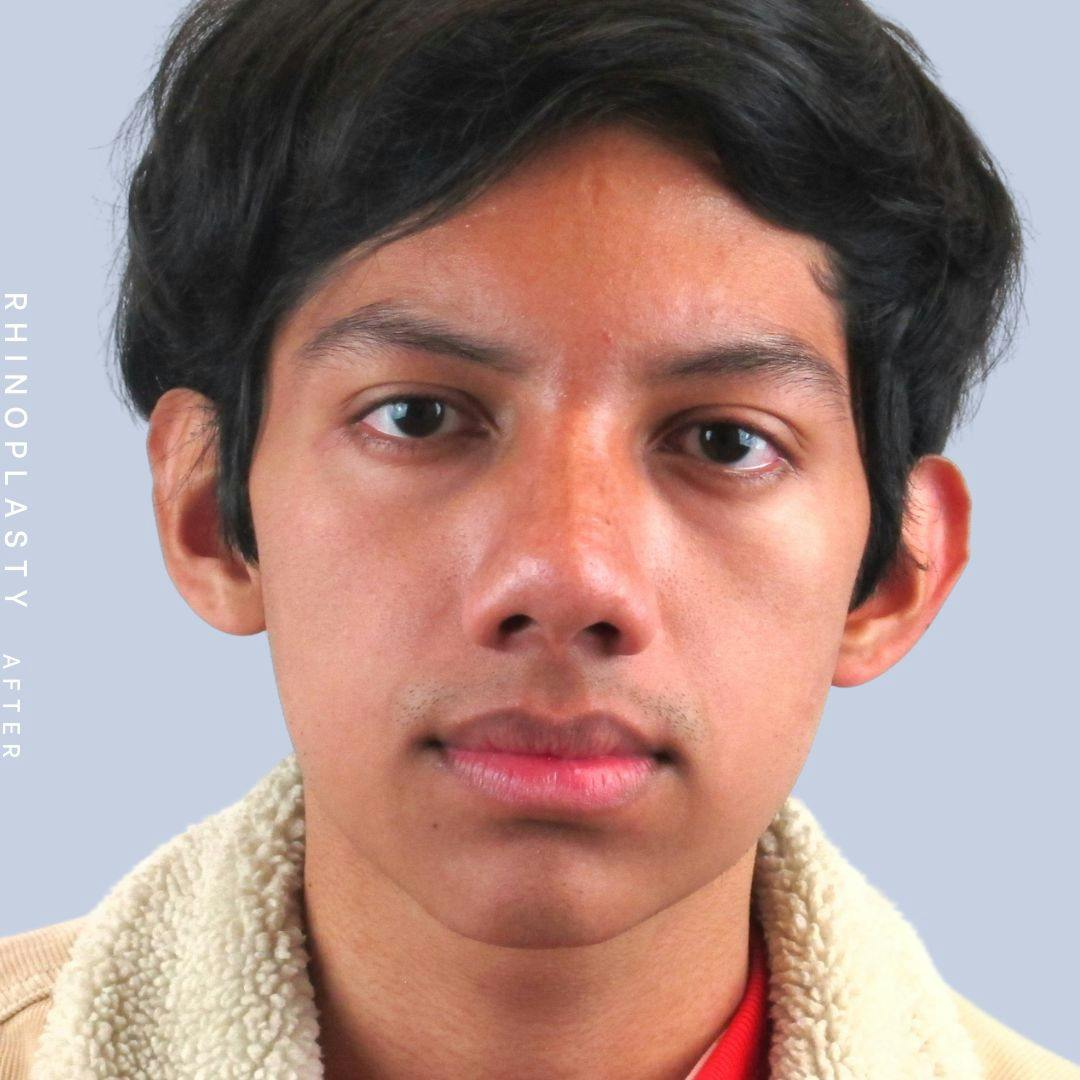 Nose Before & After Gallery - Patient 108743681 - Image 2