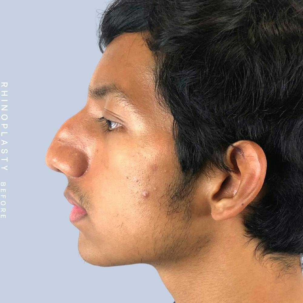 Nose Before & After Gallery - Patient 108743681 - Image 3
