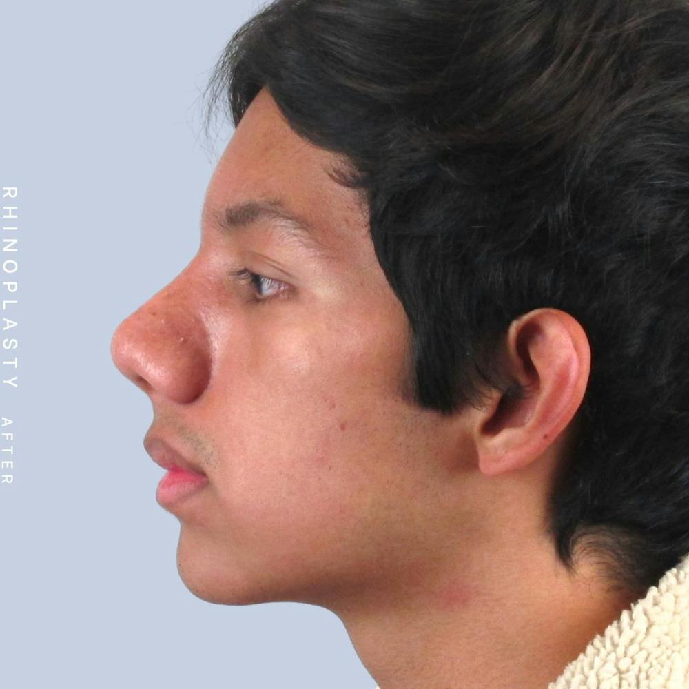 Nose Before & After Gallery - Patient 108763902 - Image 4
