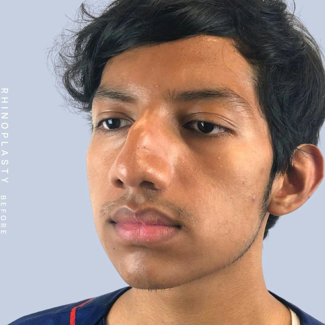 Nose Before & After Gallery - Patient 108743681 - Image 5