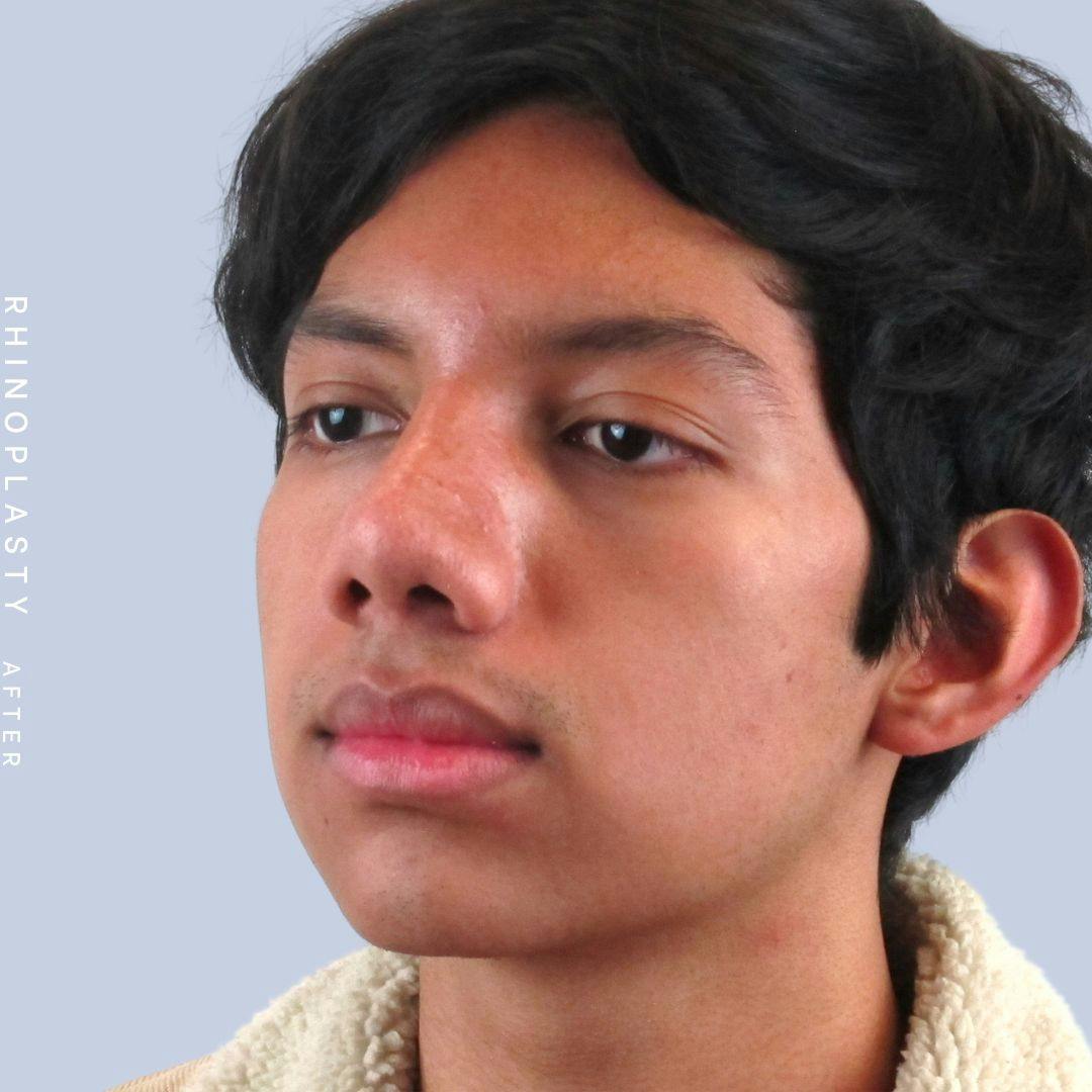 Nose Before & After Gallery - Patient 108743681 - Image 6