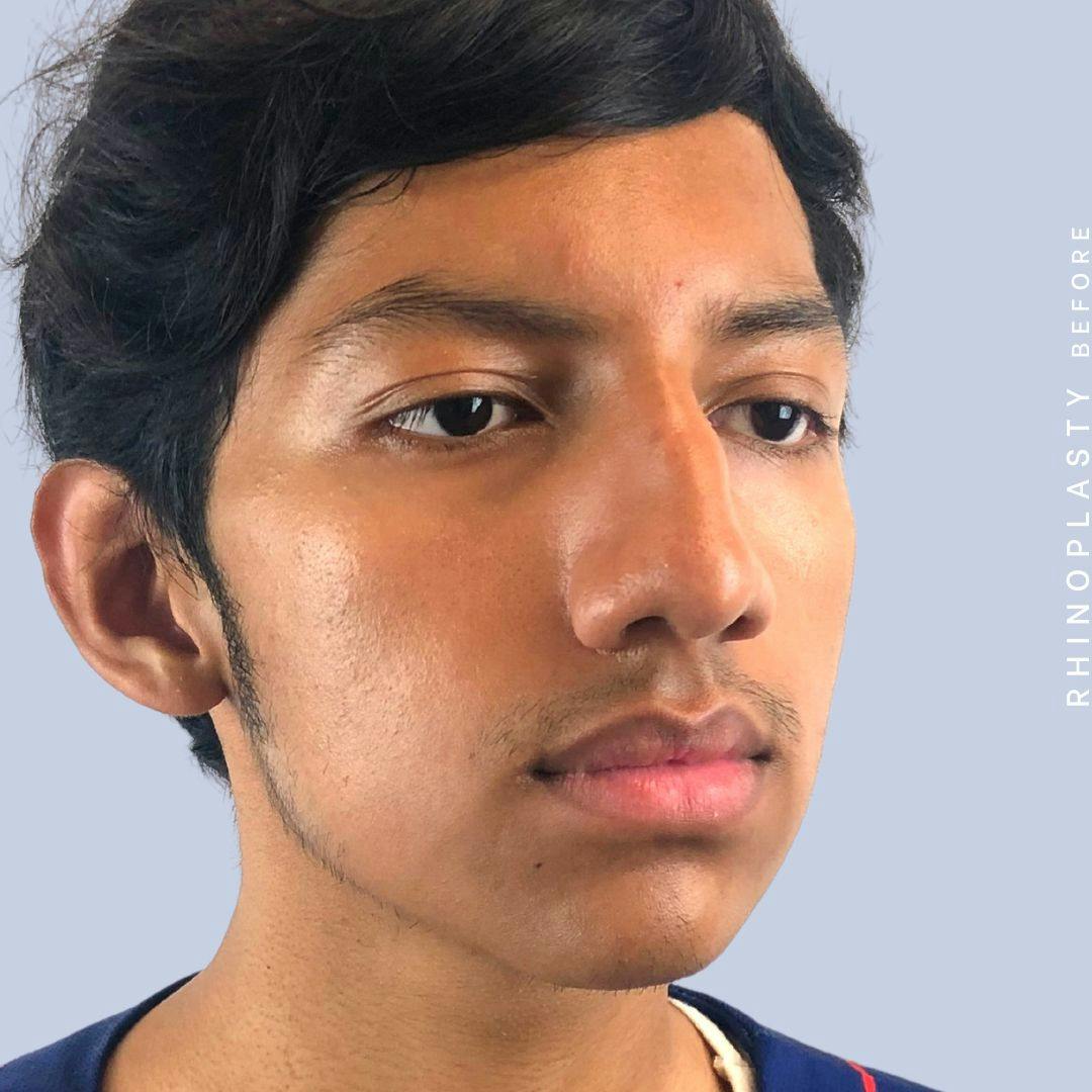 Nose Before & After Gallery - Patient 108743681 - Image 7