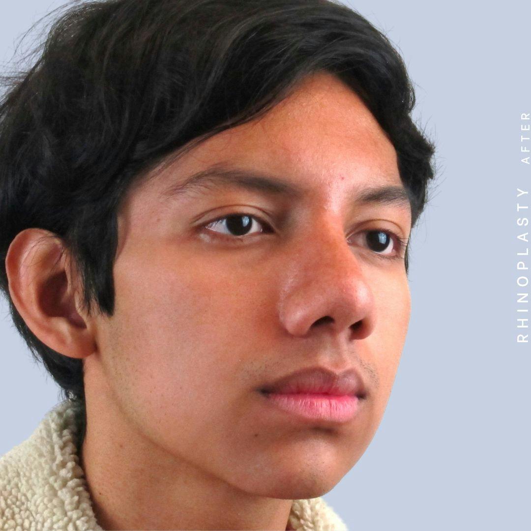 Nose Before & After Gallery - Patient 108743681 - Image 8