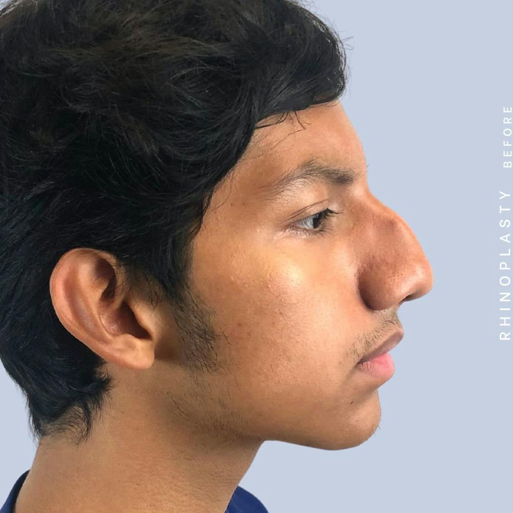 Men's Nose Before & After Gallery - Patient 108763902 - Image 9