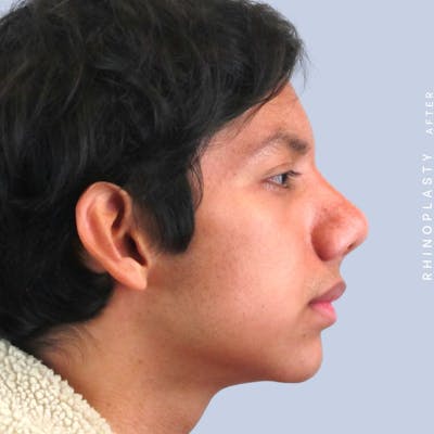 Men's Nose Before & After Gallery - Patient 108763902 - Image 10