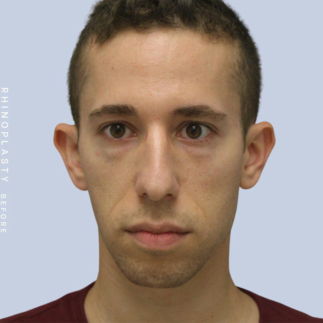 Nose Before & After Gallery - Patient 108743682 - Image 1