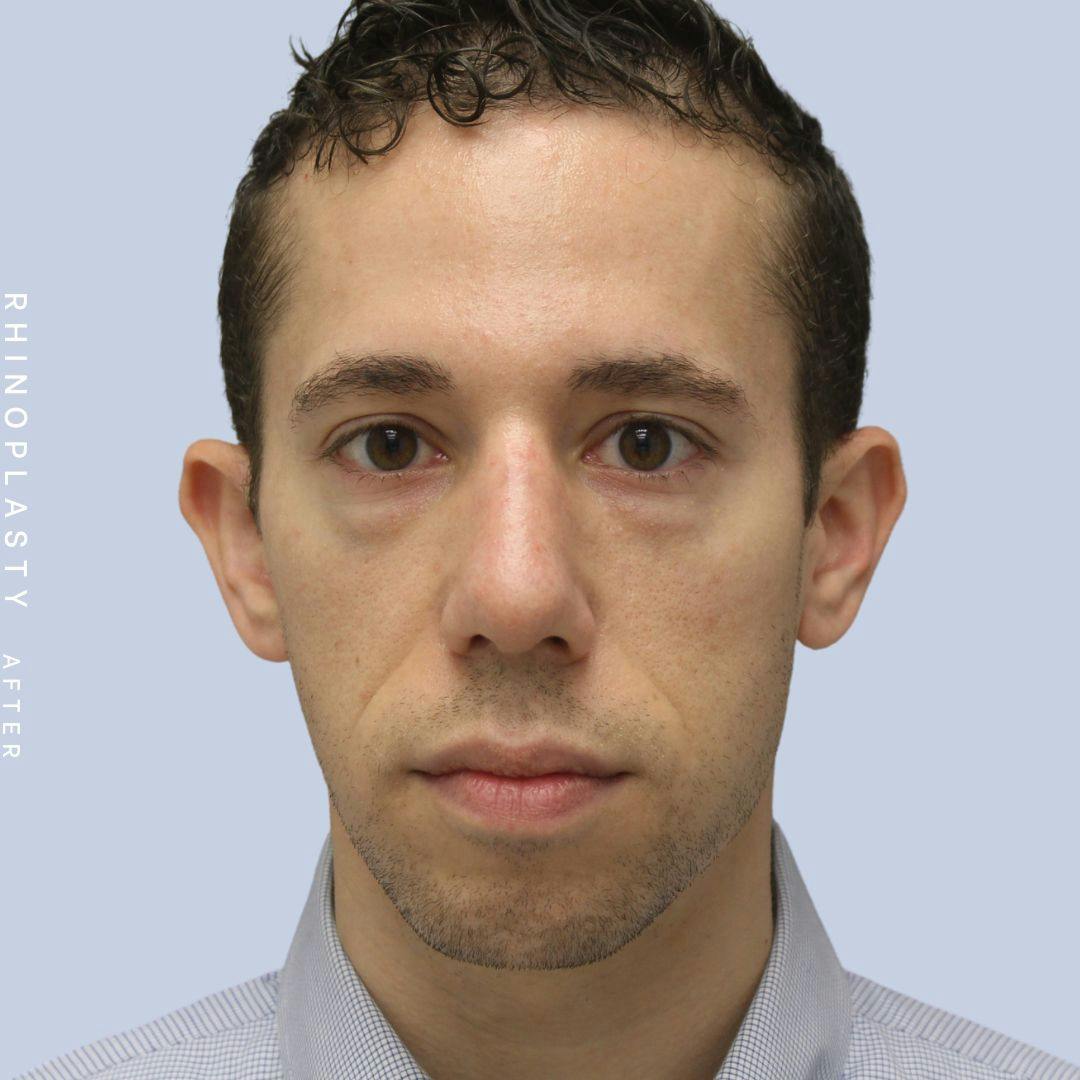 Nose Before & After Gallery - Patient 108743682 - Image 2