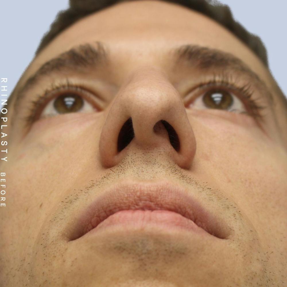 Nose Before & After Gallery - Patient 108743682 - Image 3