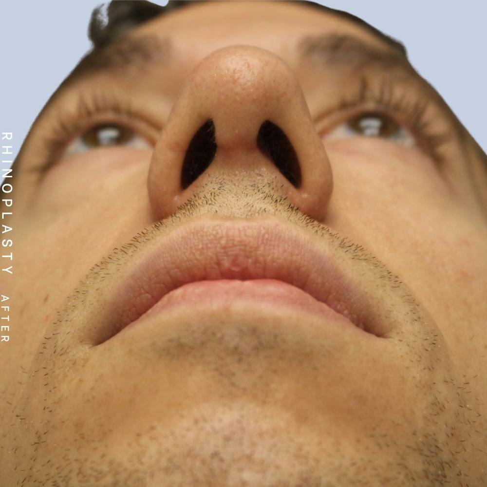 Men's Nose Before & After Gallery - Patient 108763903 - Image 4