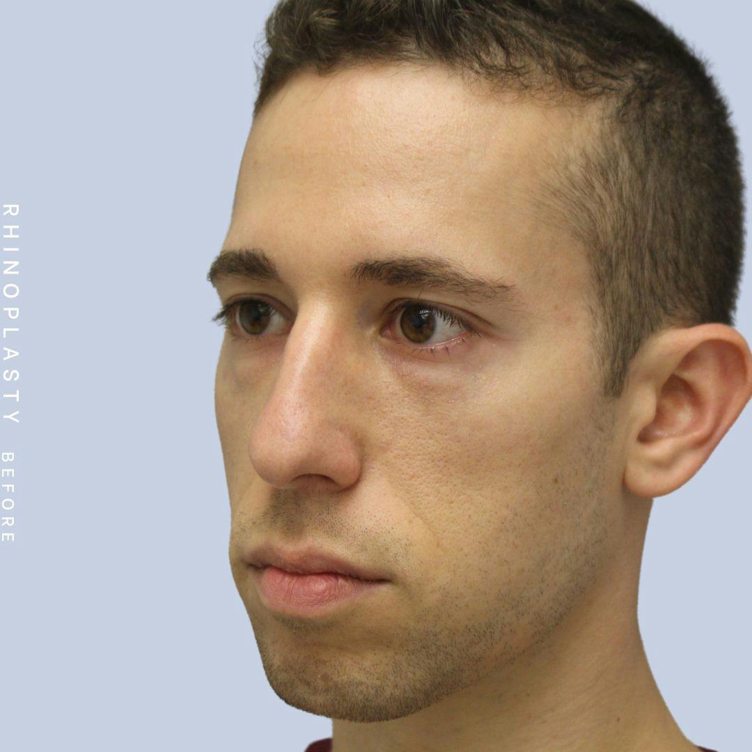 Nose Before & After Gallery - Patient 108743682 - Image 5