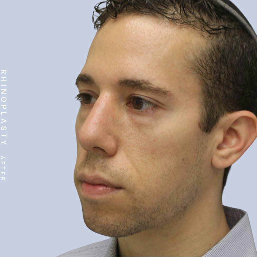 Nose Before & After Gallery - Patient 108743682 - Image 6