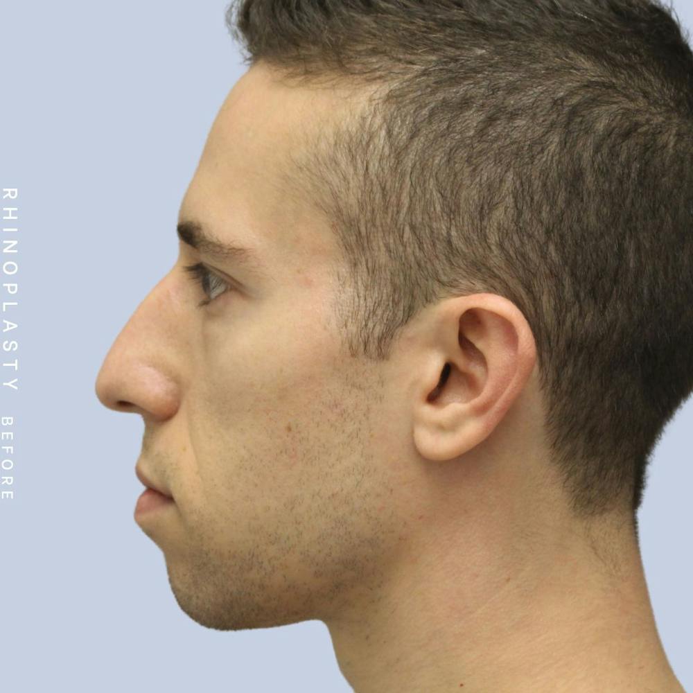 Nose Before & After Gallery - Patient 108763903 - Image 7