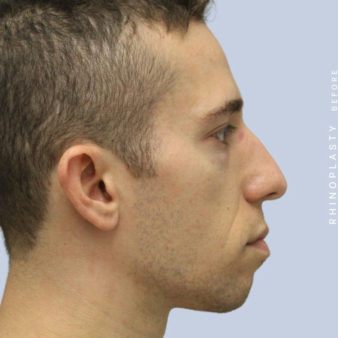 Nose Before & After Gallery - Patient 108743682 - Image 9