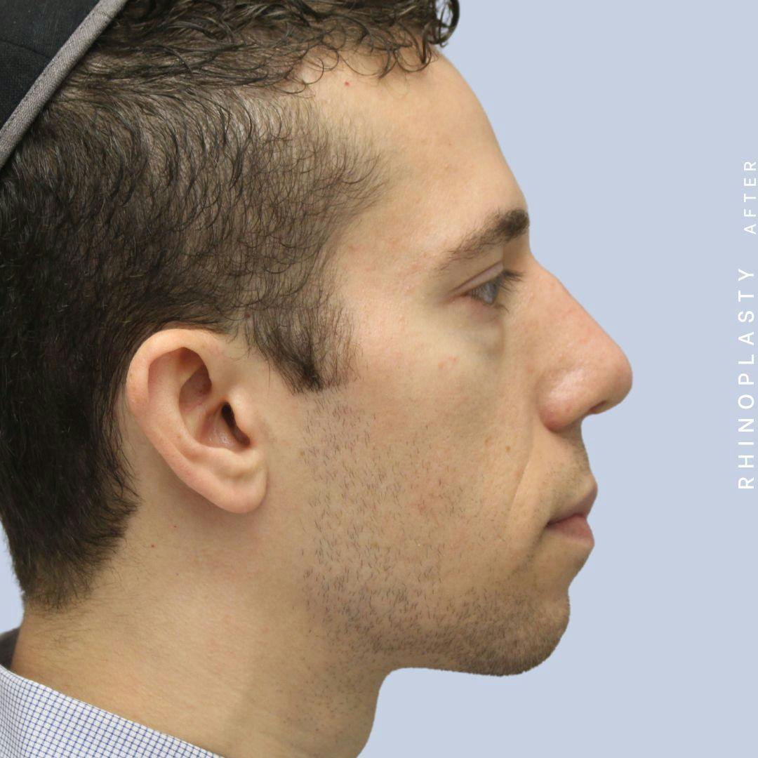 Nose Before & After Gallery - Patient 108743682 - Image 10