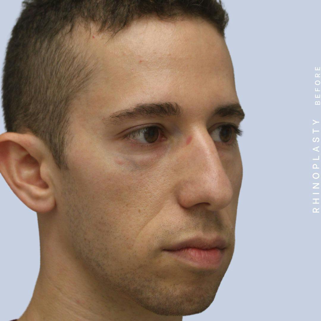 Nose Before & After Gallery - Patient 108743682 - Image 11