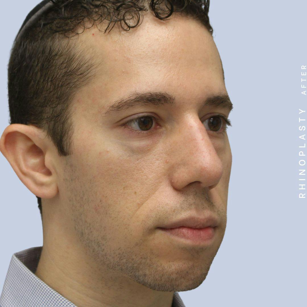 Nose Before & After Gallery - Patient 108743682 - Image 12