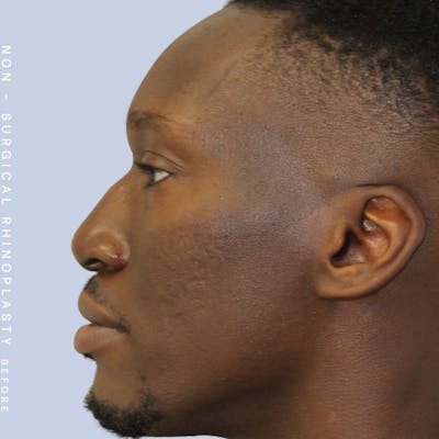 Nose Before & After Gallery - Patient 108763904 - Image 1