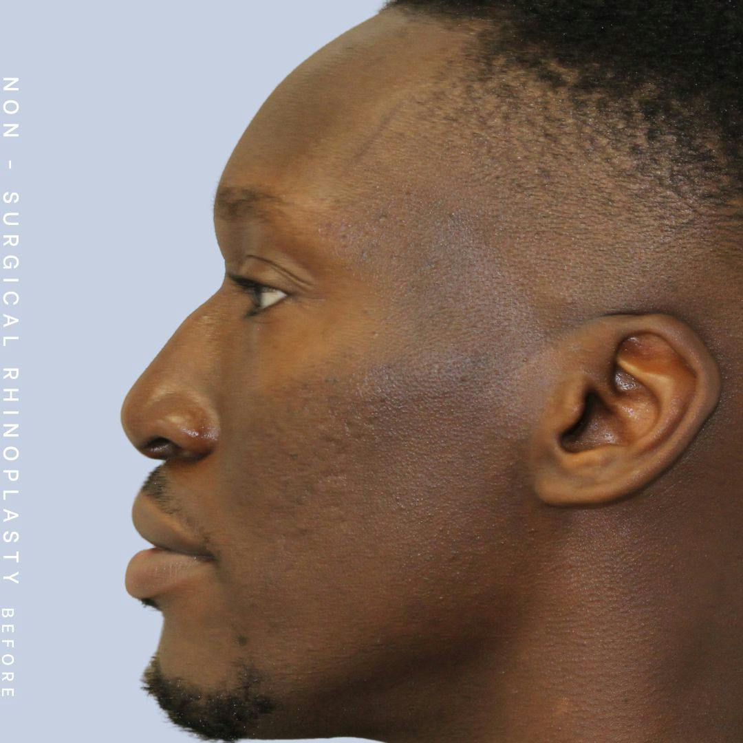 Men's Nose Before & After Gallery - Patient 108763904 - Image 1