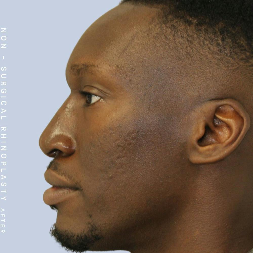 Nose Before & After Gallery - Patient 108763904 - Image 2