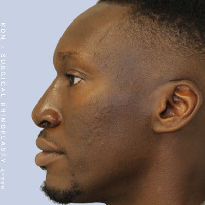 Nose Before & After Gallery - Patient 108763904 - Image 2