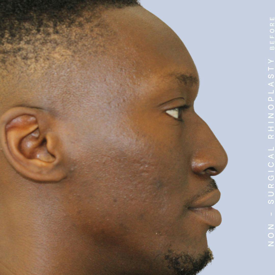 Men's Nose Before & After Gallery - Patient 108763904 - Image 3