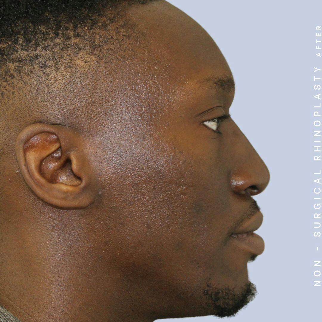 Men's Nose Before & After Gallery - Patient 108763904 - Image 4