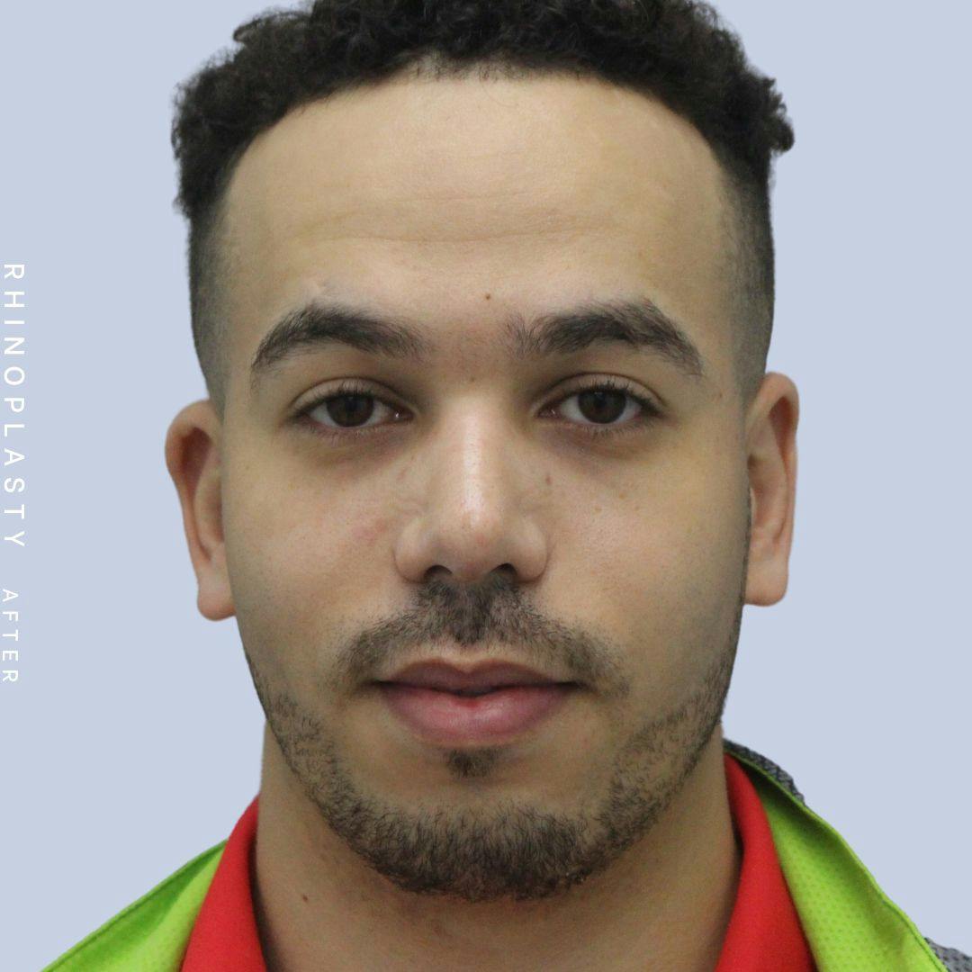 Nose Before & After Gallery - Patient 120868237 - Image 2