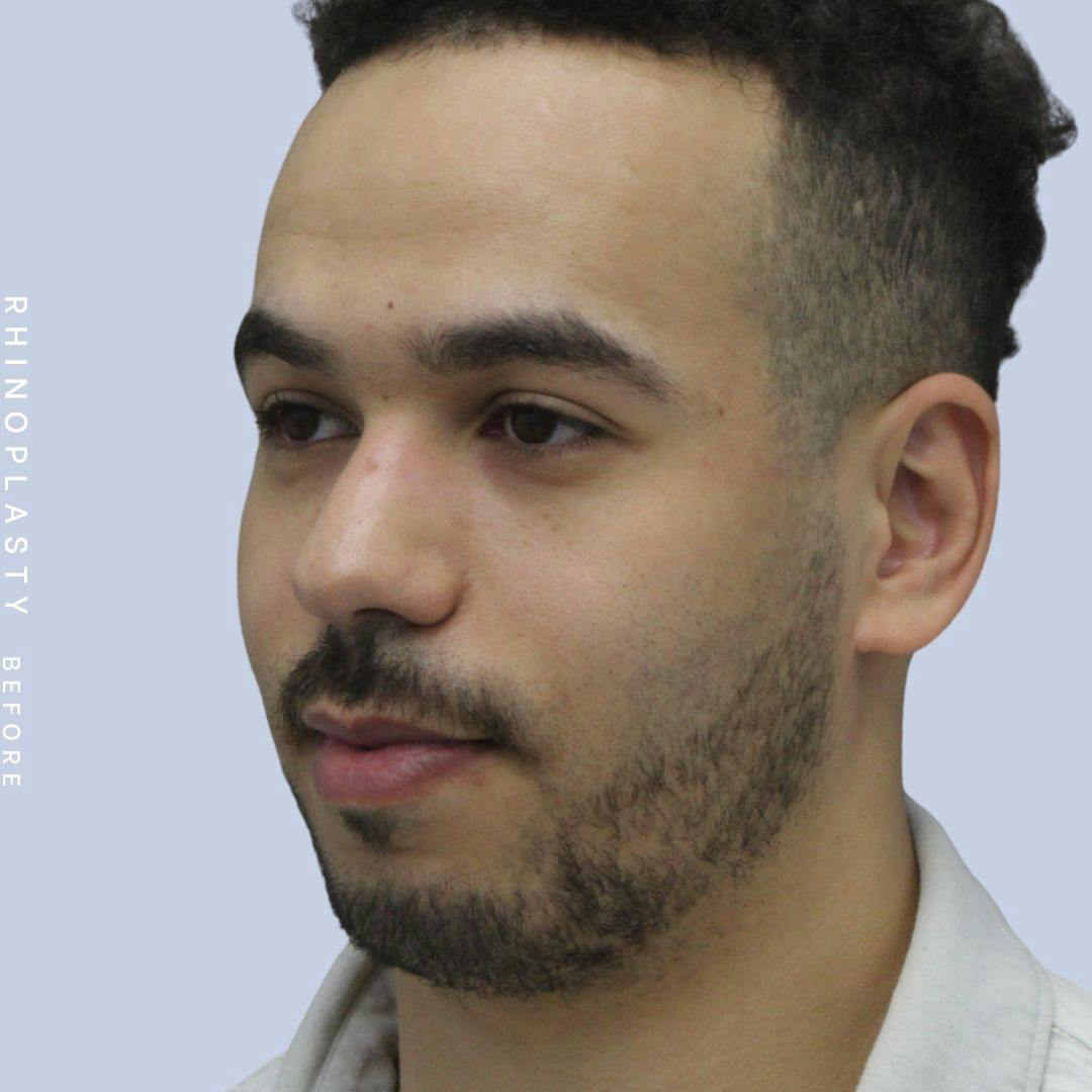 Nose Before & After Gallery - Patient 120868237 - Image 3