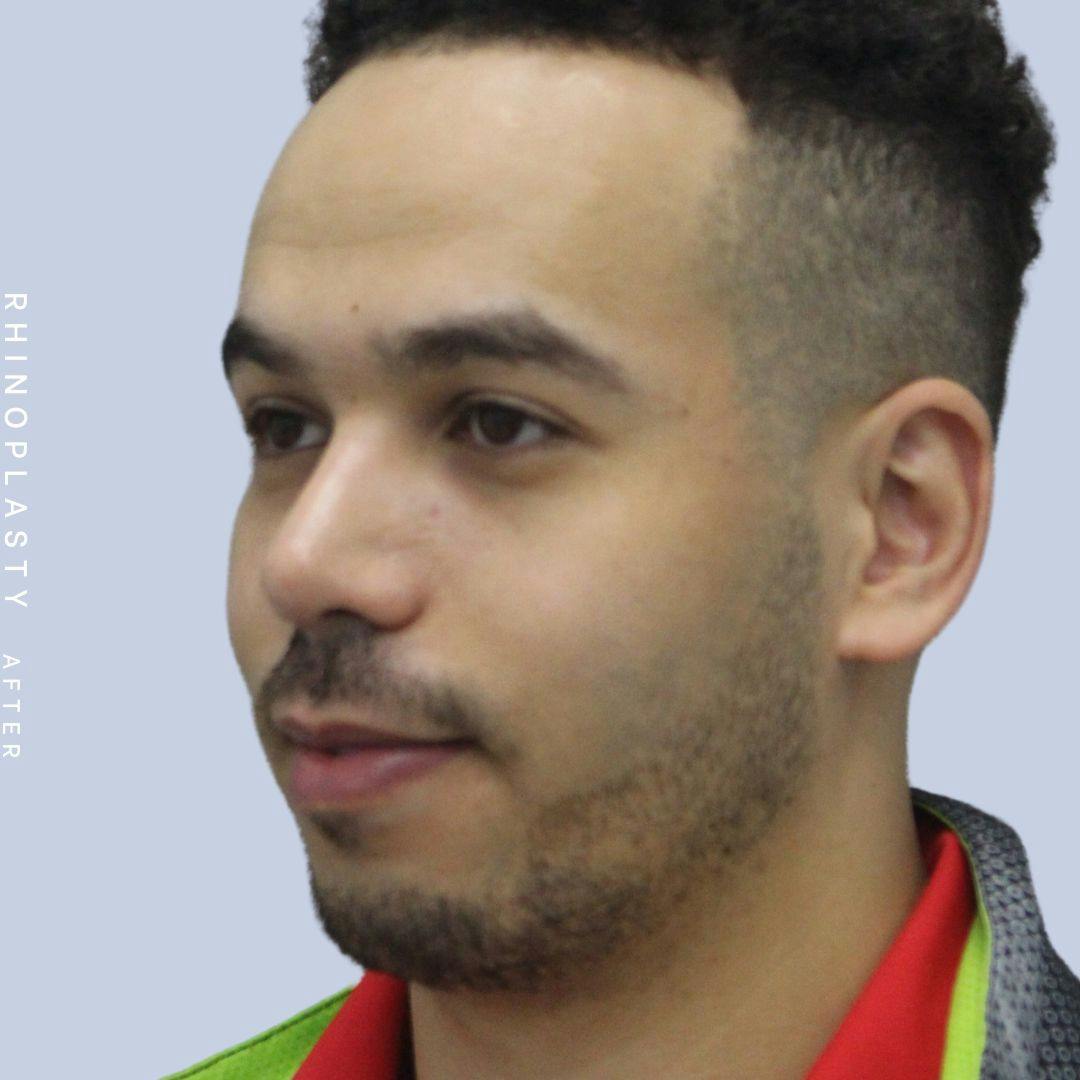 Nose Before & After Gallery - Patient 120868237 - Image 4