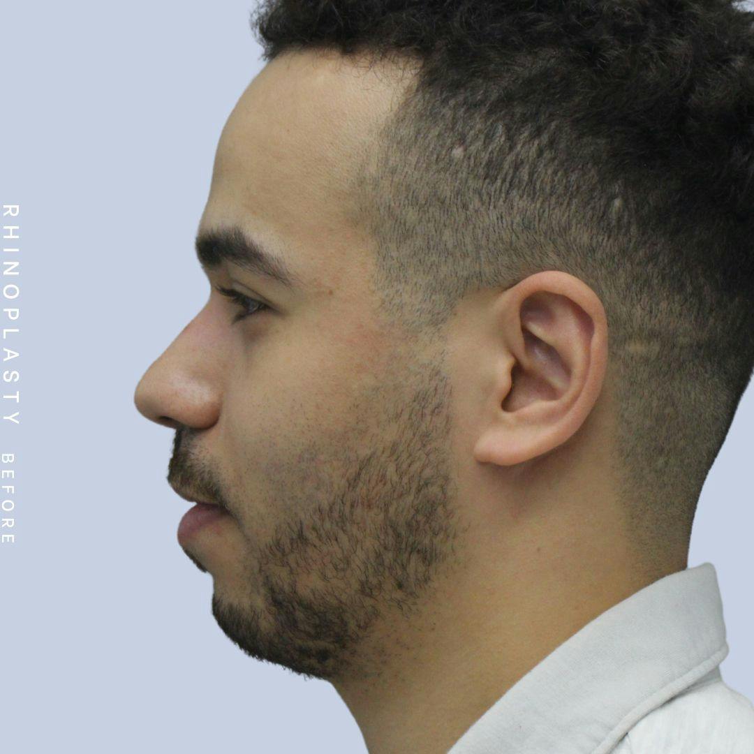 Nose Before & After Gallery - Patient 120868237 - Image 5