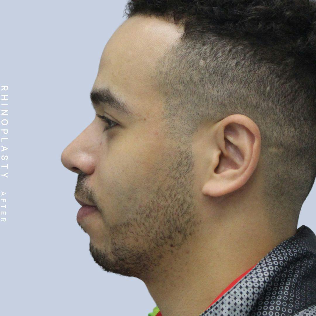 Nose Before & After Gallery - Patient 120868237 - Image 6