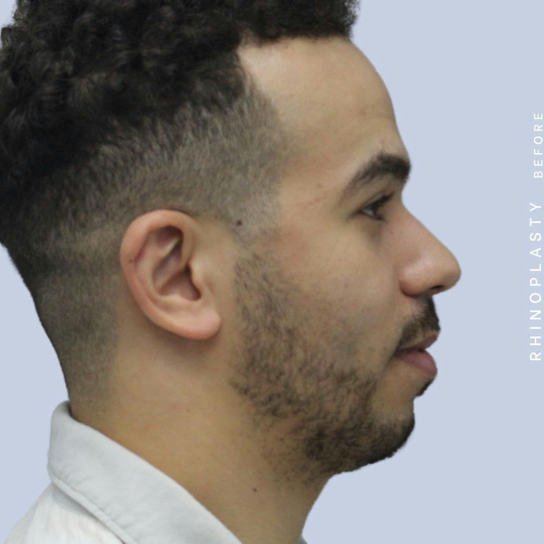 Nose Before & After Gallery - Patient 120868237 - Image 7