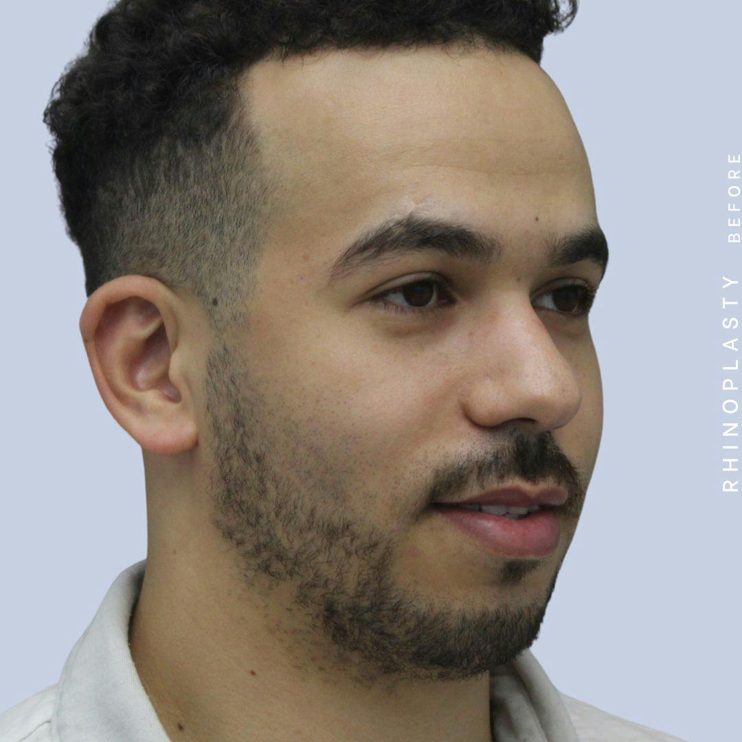 Nose Before & After Gallery - Patient 120868237 - Image 9