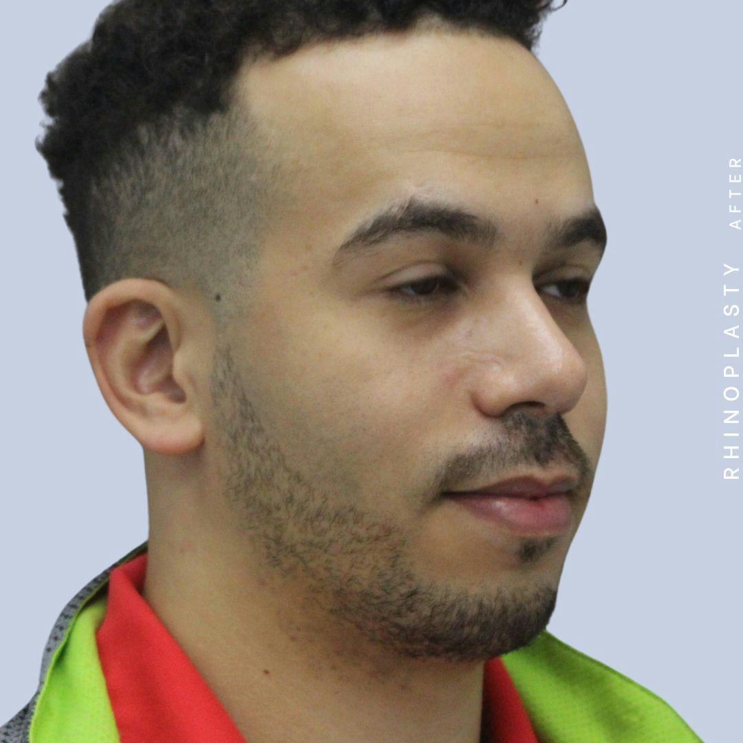 Nose Before & After Gallery - Patient 120868237 - Image 10