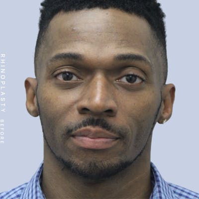 Nose Before & After Gallery - Patient 120868321 - Image 1