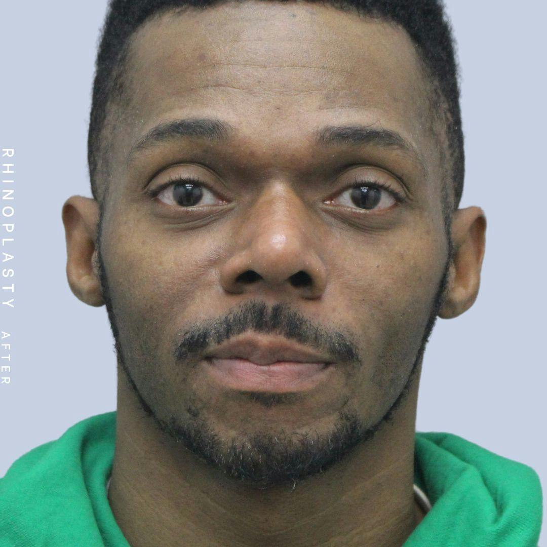 Nose Before & After Gallery - Patient 120868321 - Image 2