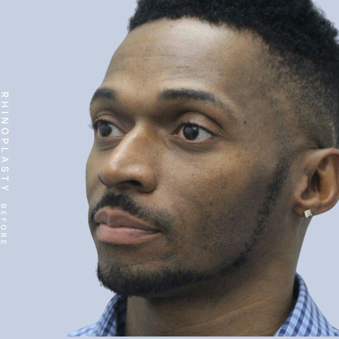 Nose Before & After Gallery - Patient 120868321 - Image 3