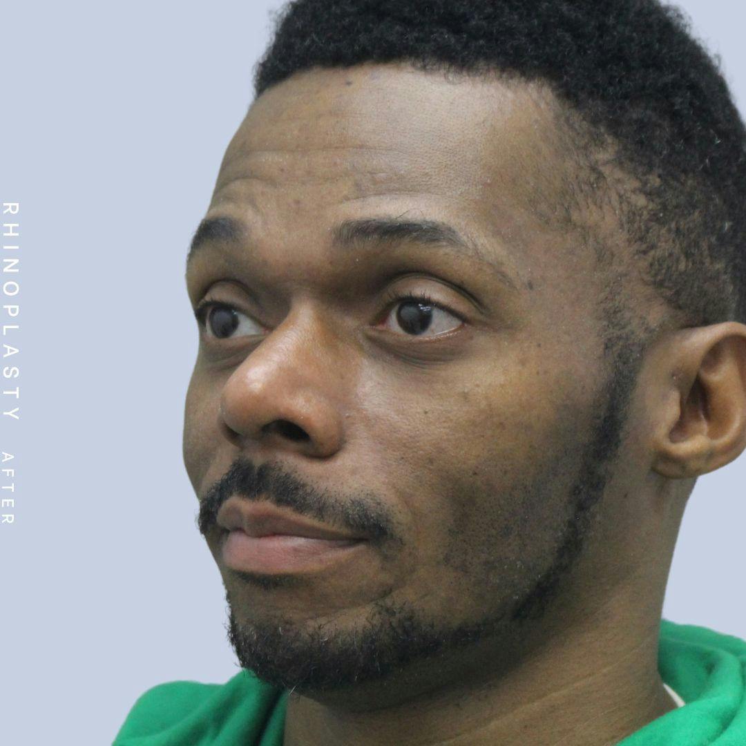 Nose Before & After Gallery - Patient 120868321 - Image 4