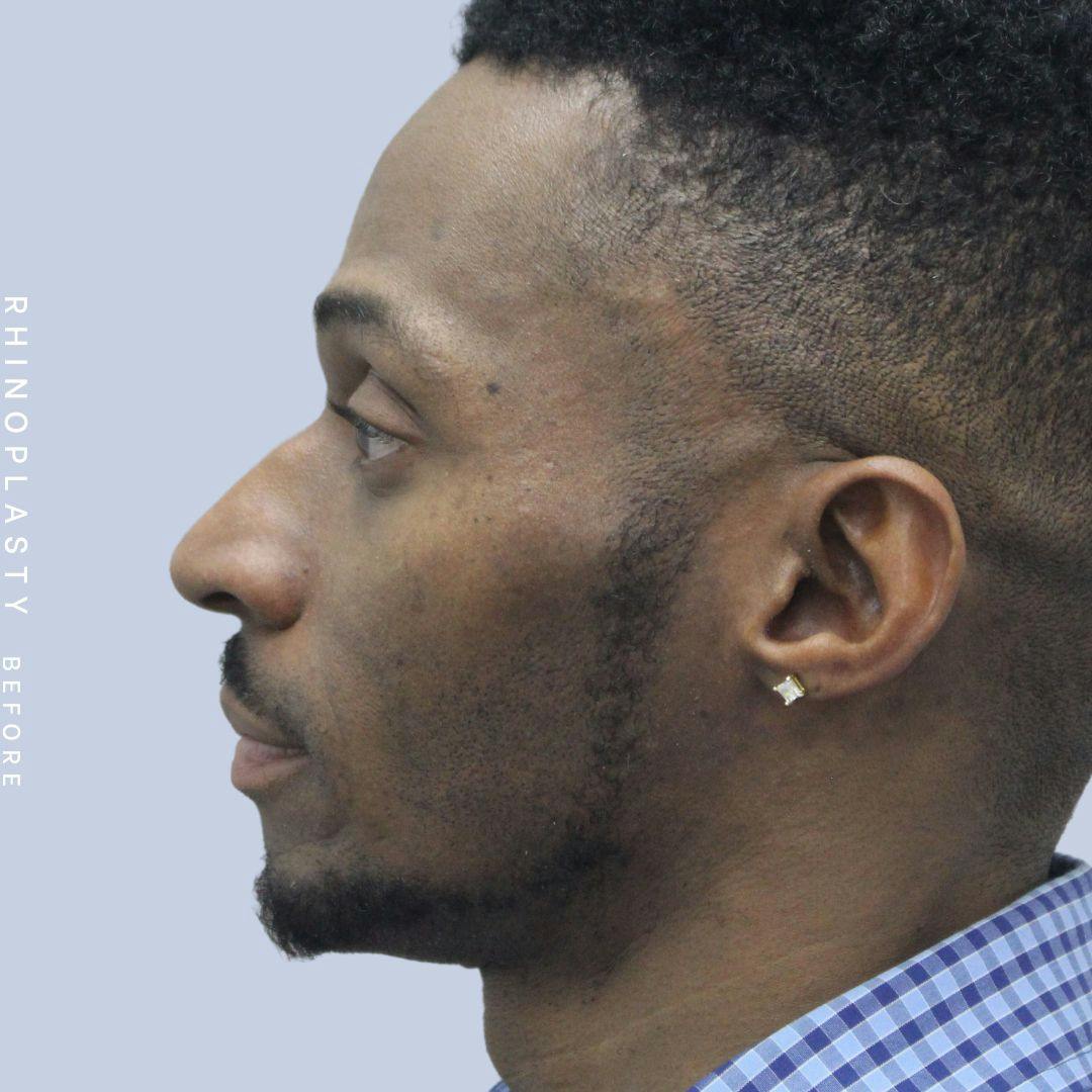 Nose Before & After Gallery - Patient 120868321 - Image 5