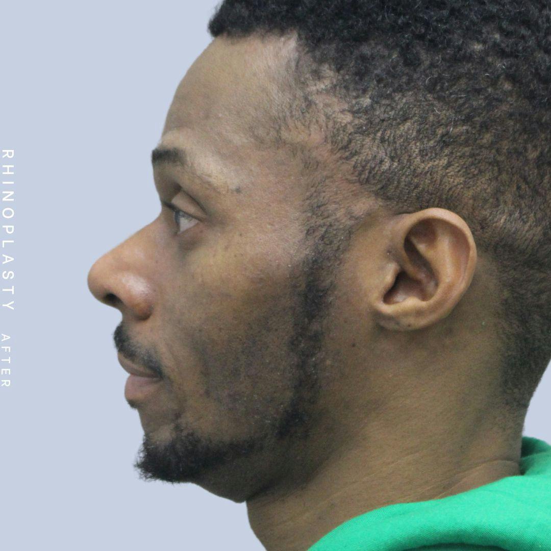 Nose Before & After Gallery - Patient 120868321 - Image 6