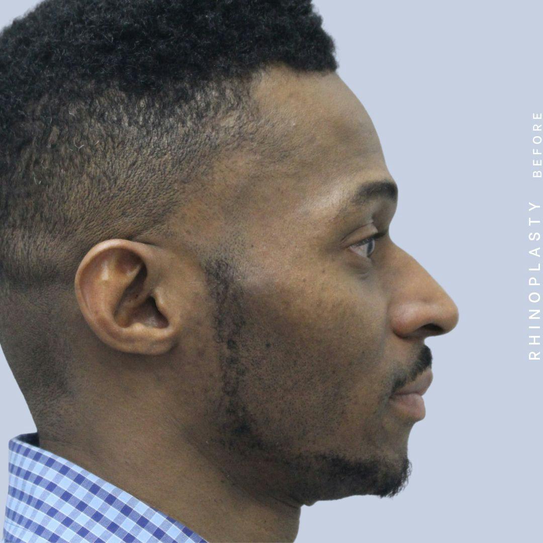 Nose Before & After Gallery - Patient 120868321 - Image 7