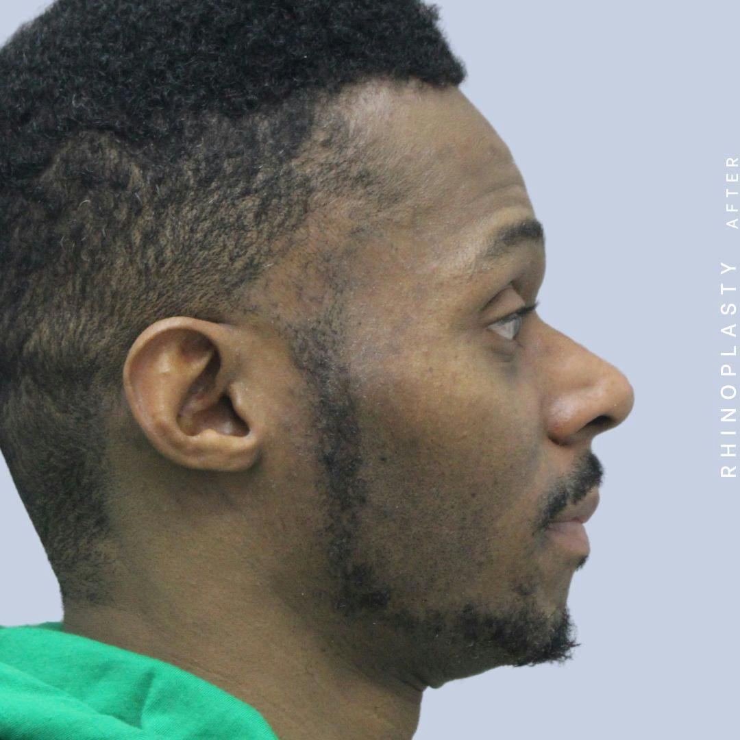 Nose Before & After Gallery - Patient 120868321 - Image 8