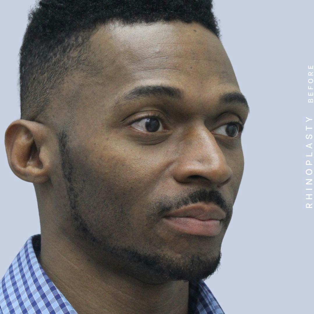 Nose Before & After Gallery - Patient 120868321 - Image 9