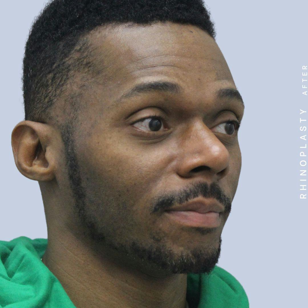 Nose Before & After Gallery - Patient 120868321 - Image 10