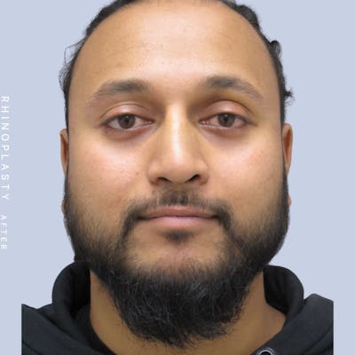 Nose Before & After Gallery - Patient 120868334 - Image 2