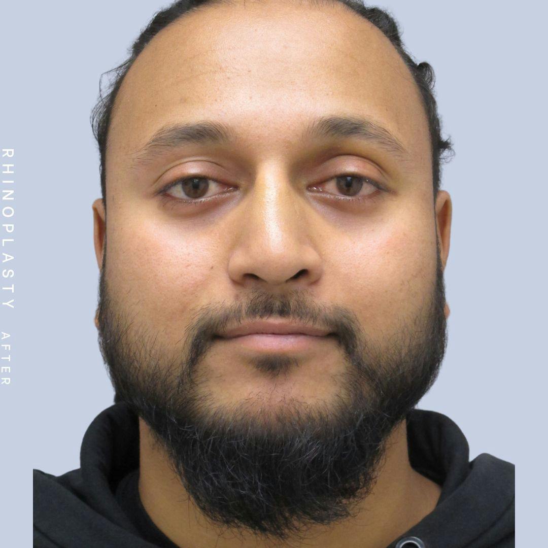 Nose Before & After Gallery - Patient 120868334 - Image 2