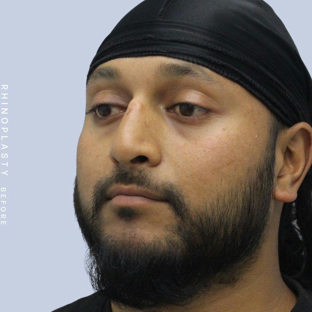 Nose Before & After Gallery - Patient 120868334 - Image 3