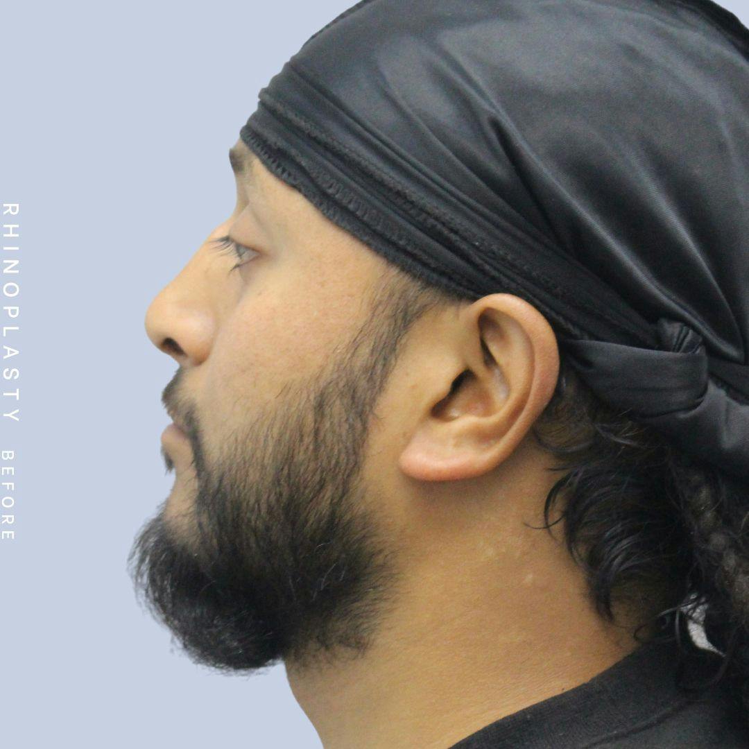 Nose Before & After Gallery - Patient 120868334 - Image 5